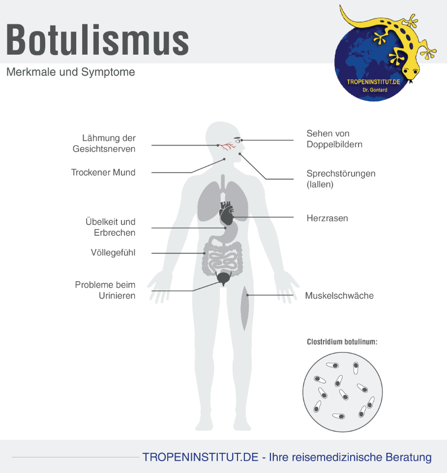 Botulismus Krankheit Verlauf