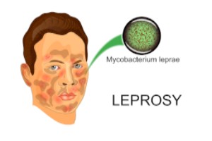 Lepra