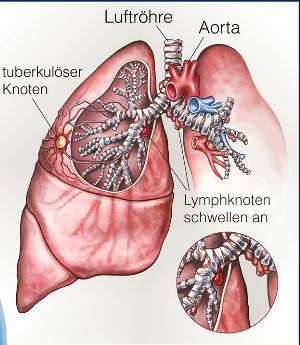 Tuberkulose