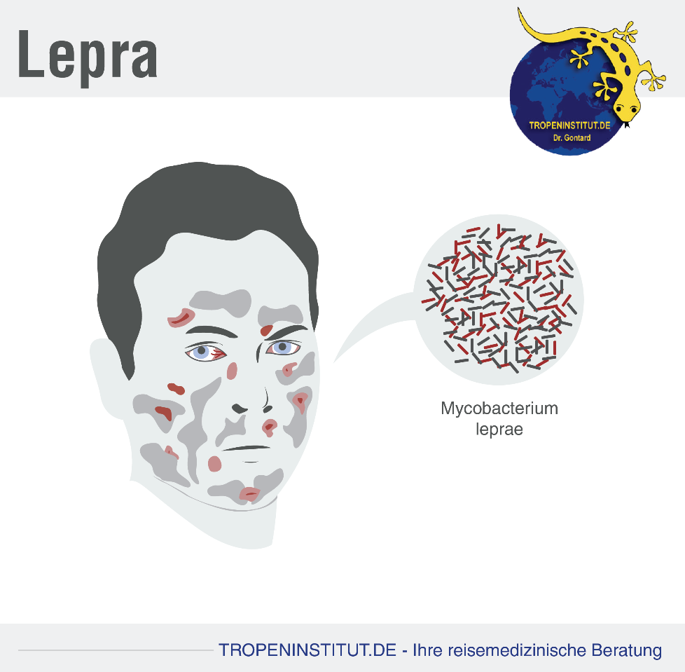 Lepra - bakterielle Infektion