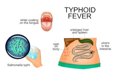 Typhus Übertragung